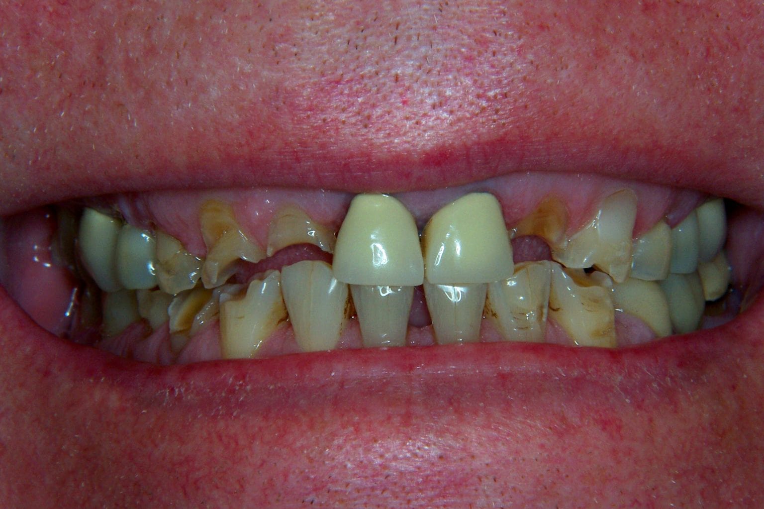 Close-up of a person's mouth showing severely decayed, discolored, and damaged teeth, with two visible dental crowns on the front teeth.