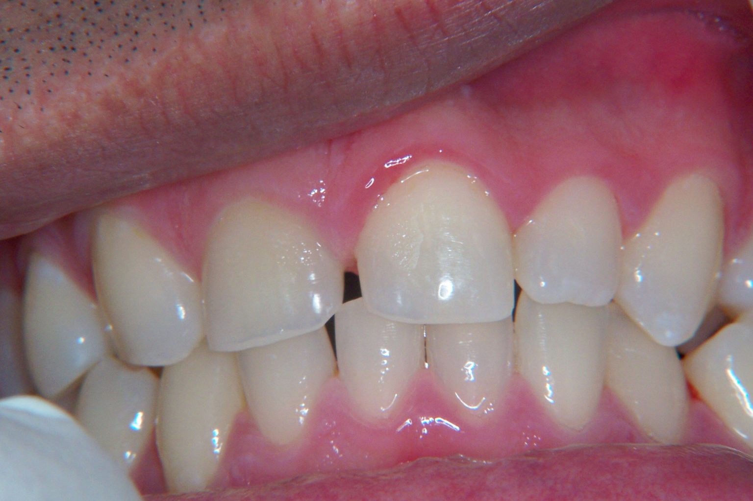 Close-up of a person's teeth and gums, showing mild inflammation and slight misalignment of the upper front teeth.