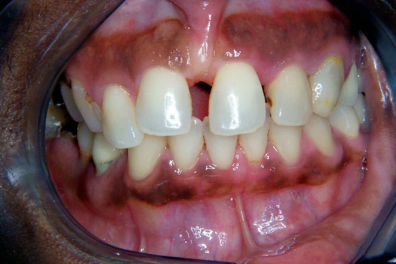 Close-up of a person's mouth showing severe dental issues, including missing upper front teeth, misalignment, discoloration, and gum pigmentation. A dental retractor is used to keep the mouth open.