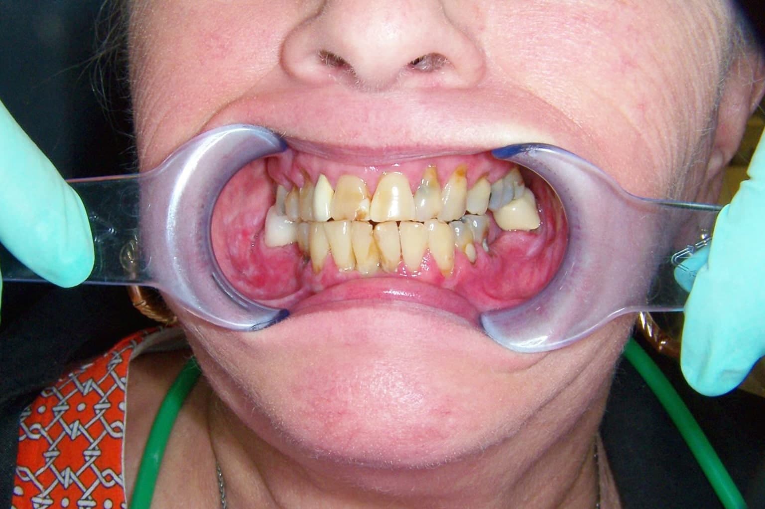 Close-up of a person's mouth held open with a dental retractor, showing severely decayed, misaligned, and discolored teeth with gum inflammation.