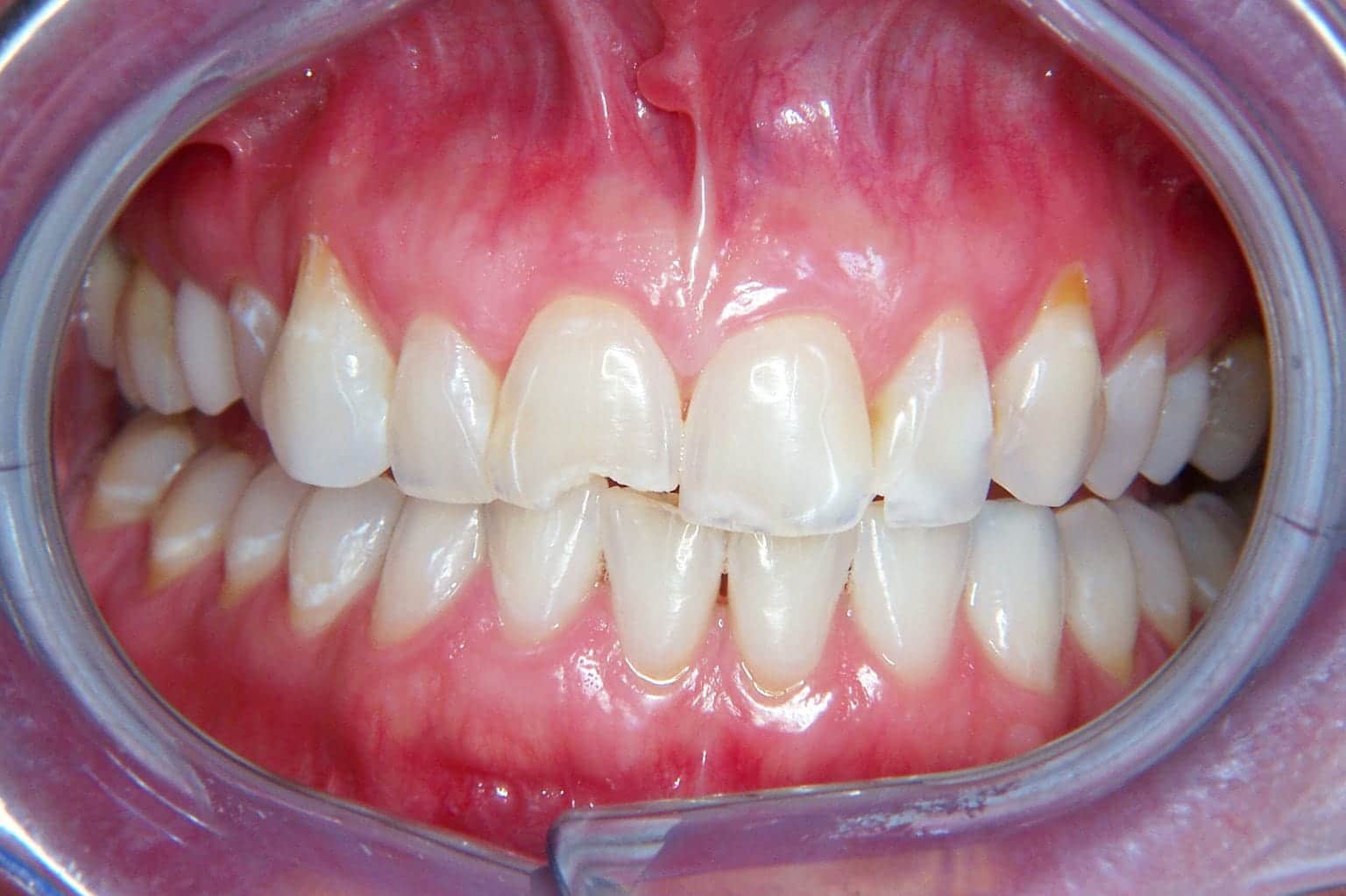 Close-up of a person's mouth held open with a dental retractor, showing slightly misaligned but generally healthy teeth with some enamel wear.