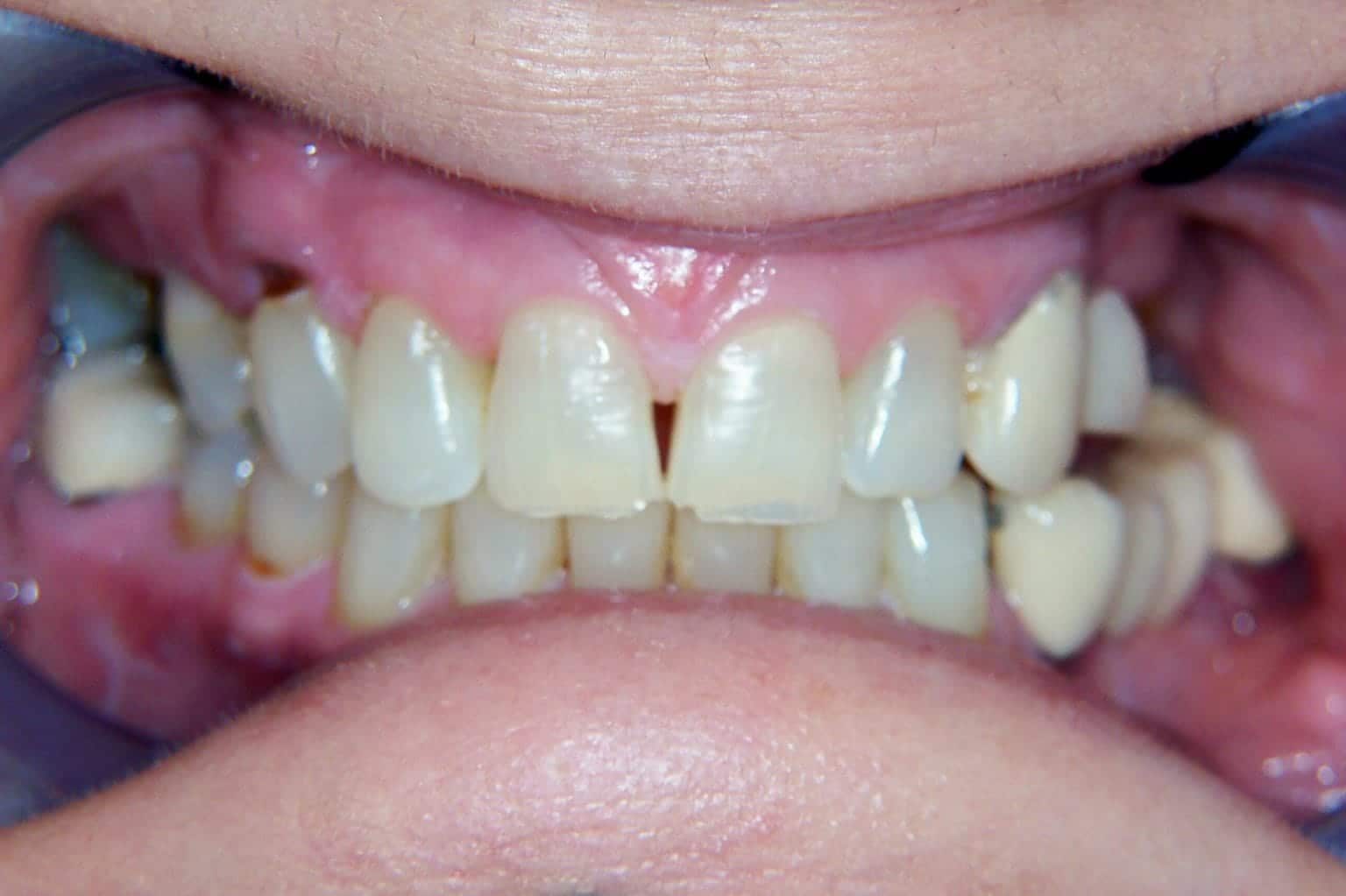 Close-up of a person's teeth showing discoloration, misalignment, gaps, and signs of dental issues.