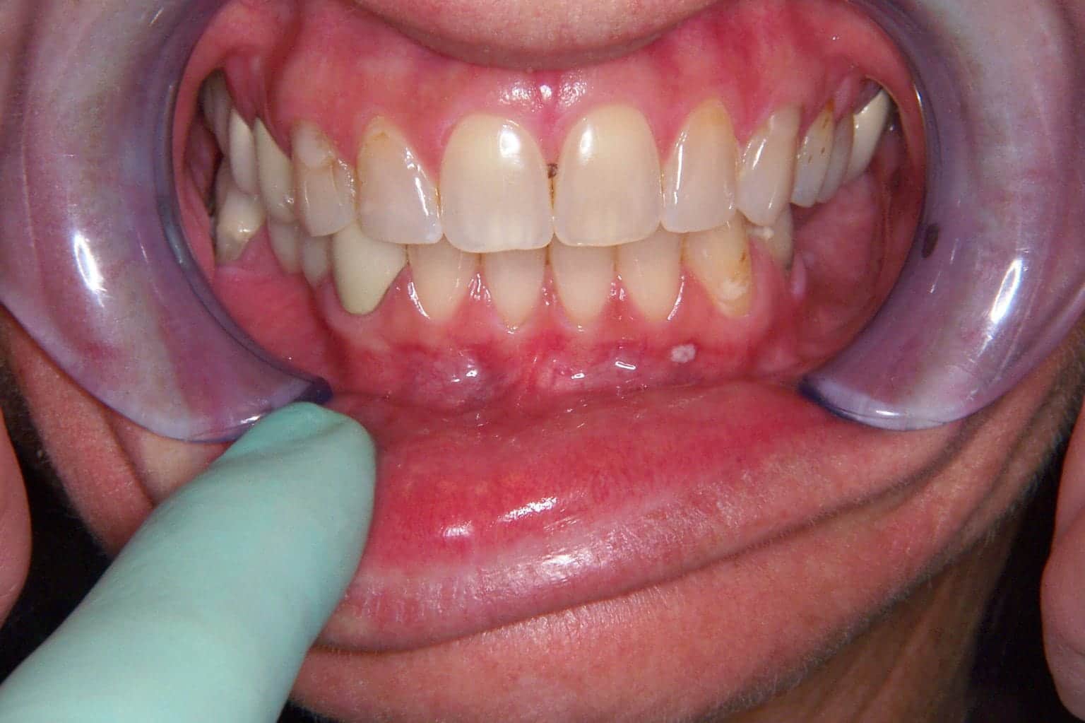 Close-up of a person's teeth showing discoloration, plaque buildup, and gum inflammation, with a gloved hand pointing to the lower gums.