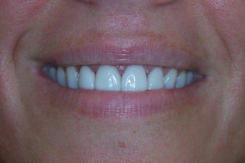 A veneers patient showing off her new smile