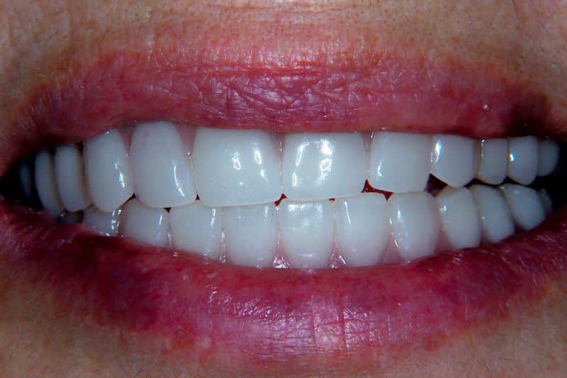 A full-mouth reconstruction patient's after image