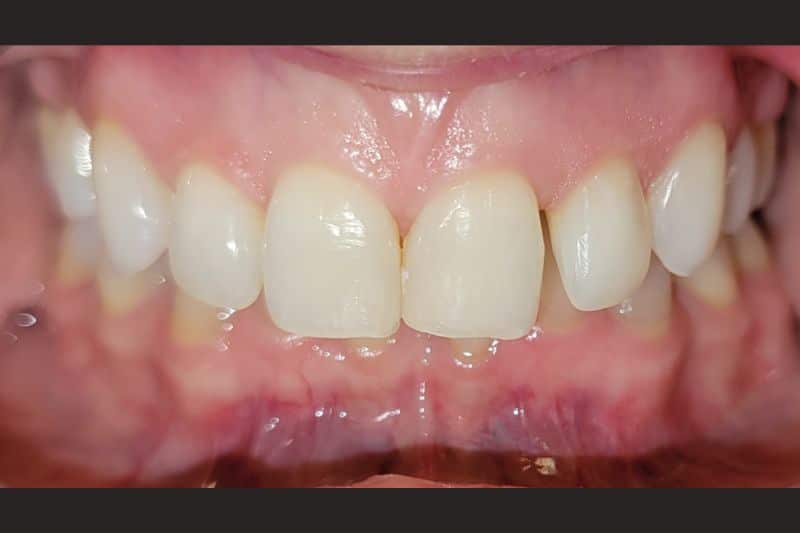 A patient's smile after having undergone neuromuscular bite correction and orthodontics