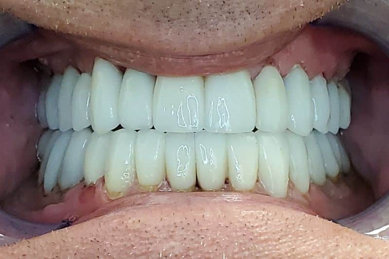 A full-mouth reconstruction patient's after image